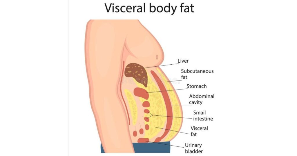 can-visceral-fat-be-removed-through-surgery-expert-guide